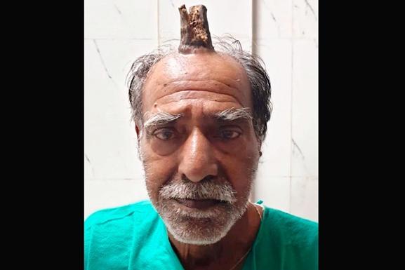 Необычная операция: пожилому индийцу удалили 10-сантиметровый «дьявольский рог»
