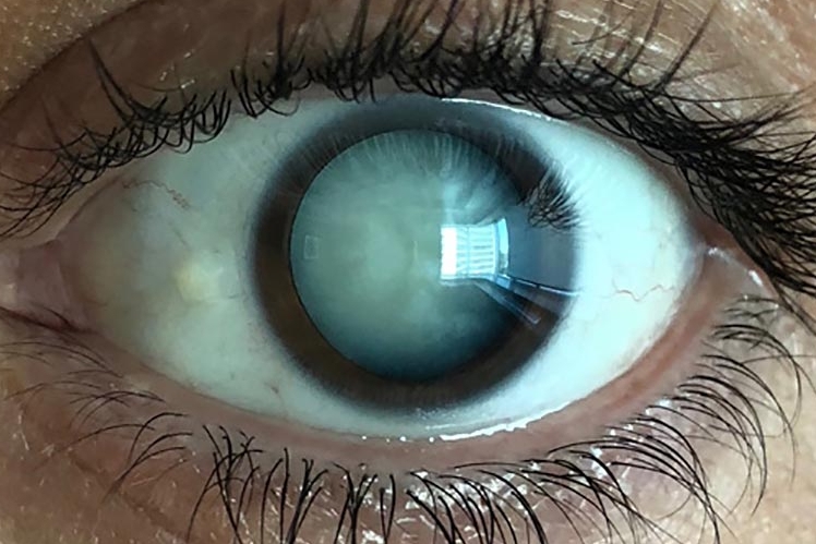 Медицина будущего: революционное открытие позволит лечить катаракту без хирургического вмешательства 