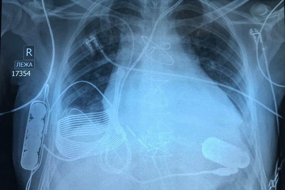 Шаг вперед: врачи впервые внедрили пациенту «бионическое сердце» с возможностью беспроводной зарядки