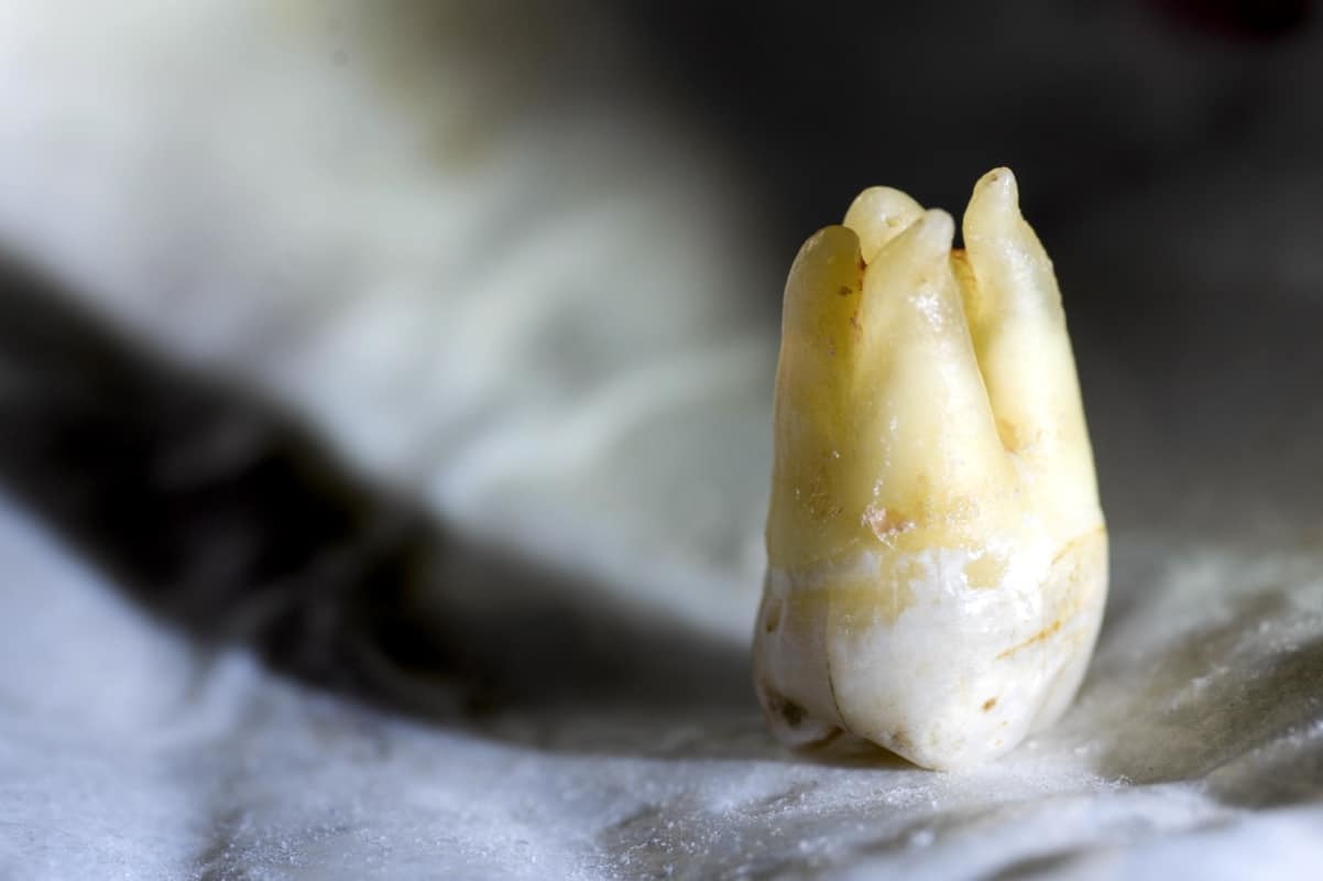 Медицина будущего: ученые разработали наноботов для лечения зубных каналов